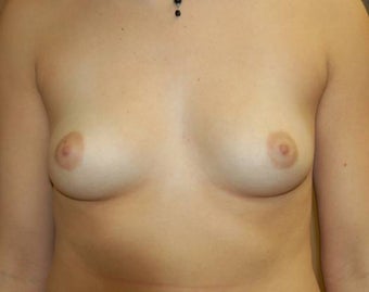 Breast-Augmentation-before-258981.jpg